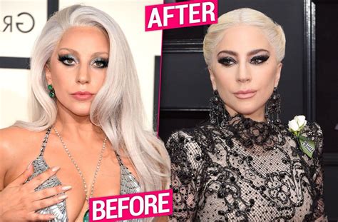 Lady Gaga Plastic Surgery